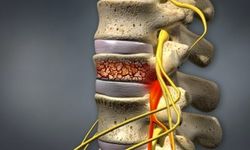 Kemik erimesi sonrası omurga kırıklarına çimento tedavisi