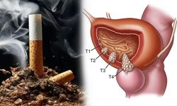 Sigara içenler dikkat! Mesane kanseri en çok onu seviyor