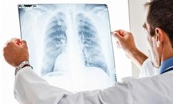 Sinsi tehdit akciğer kanseri: Erken önlem hayat kurtarır