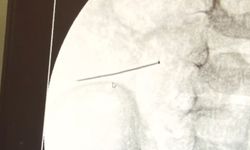 Ağrıyla kıvranan 2 yaşındaki çocuğun bağırsağından 3 santimlik iğne çıktı