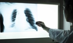 Akciğer kanseri tarama programı olursa yaklaşık 7 bin hastanın ölümü engellenebilir