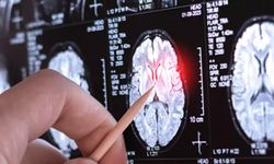 Dünya çapında sadece 13 vaka! Yeni nörolojik hastalık keşfedildi