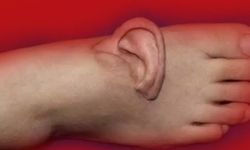 Eşi benzeri görülmemiş olay: Kulağını 5 ay ayağında taşıdı