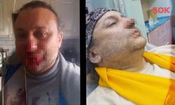 Et yiyen bakteri kabusu! Pitbull ısırmıştı, yüzü çürümeye başladı: Onur Akay entübe edildi