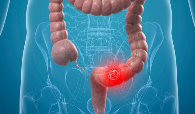 Bağırsak kanserinde sevindirici gelişme