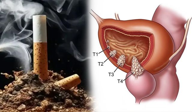 Sigara içenler dikkat! Mesane kanseri en çok onu seviyor