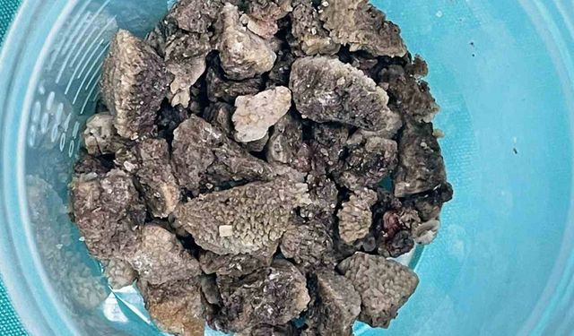 8 santimetrelik ’geyik boynuzu’ böbrek taşı kapalı yöntemle çıkarıldı