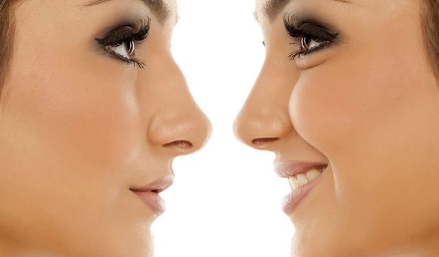 ‘Burun estetiğinde altın oran, kişiye özel belirlenmeli’