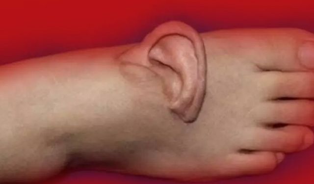 Eşi benzeri görülmemiş olay: Kulağını 5 ay ayağında taşıdı