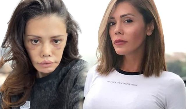 Didem Ceran kimdir, neden yüz nakli oldu? Didem Ceran kaç yaşında, aslen nereli, mesleği nedir?
