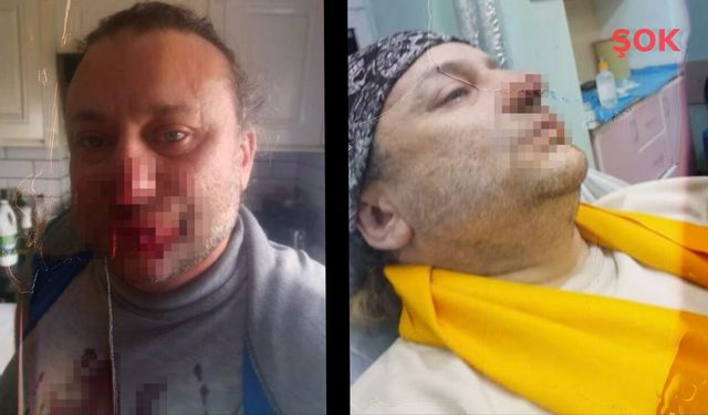 Et yiyen bakteri kabusu! Pitbull ısırmıştı, yüzü çürümeye başladı: Onur Akay entübe edildi