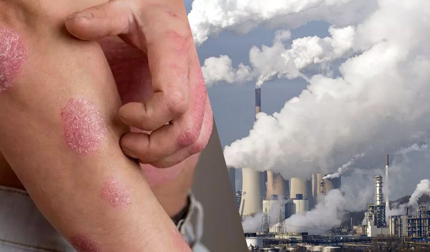 Hava kirliliği sedef hastalığı riskini artırıyor