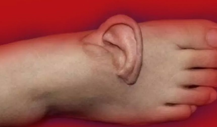 Eşi benzeri görülmemiş olay: Kulağını 5 ay ayağında taşıdı